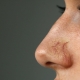 Treatment of Capillaries on the Nose With Laser - Lifeplus | Nisantasi