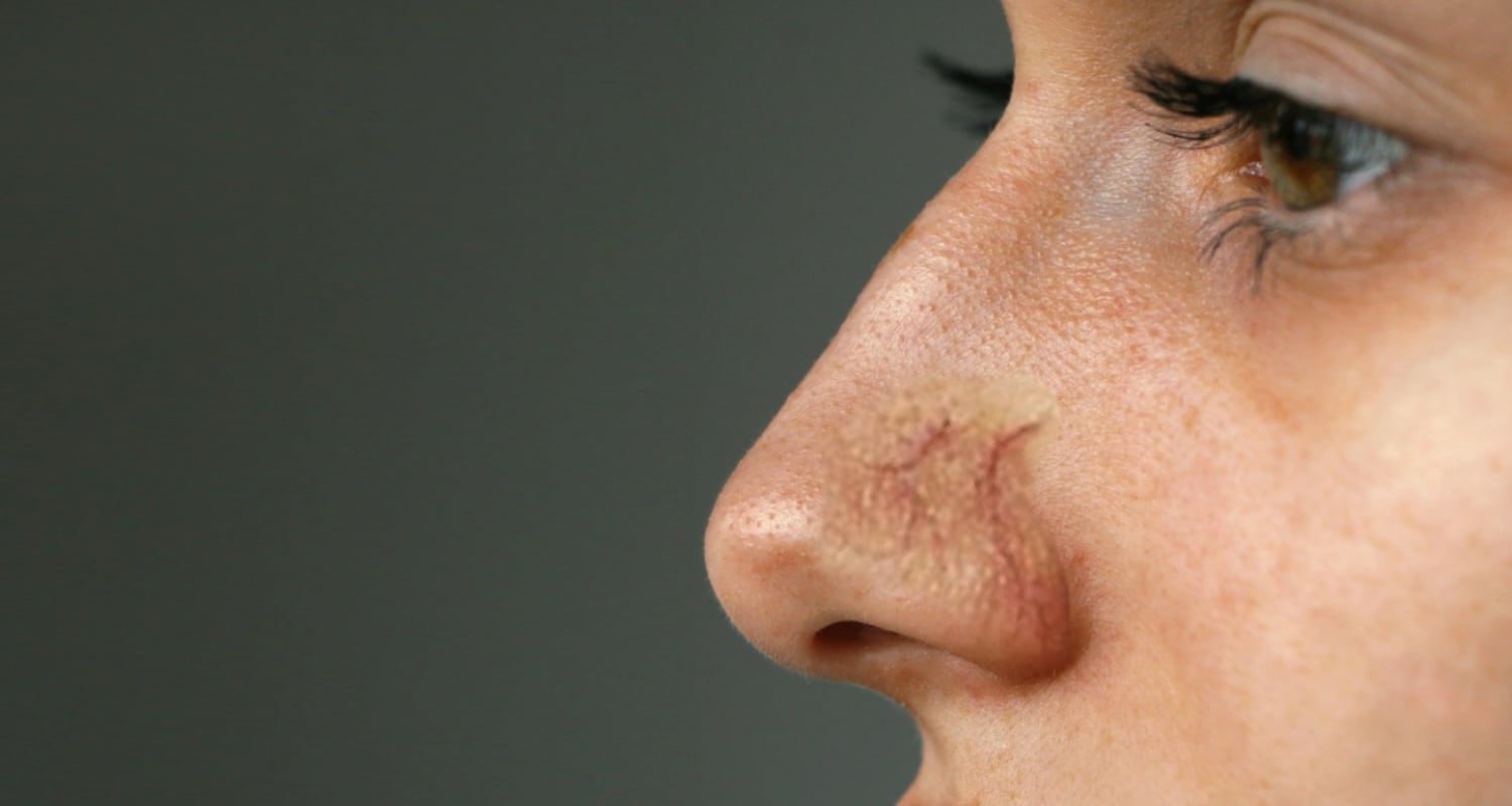 Treatment of Capillaries on the Nose With Laser - Lifeplus | Nisantasi